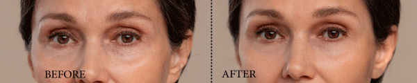 Fine Lines and Wrinkles: Can Egg White Masks Help? Exploring Natural Remedies and Vaadi Organics' Anti-Aging Cream