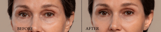 Fine Lines and Wrinkles: Can Egg White Masks Help? Exploring Natural Remedies and Vaadi Organics' Anti-Aging Cream